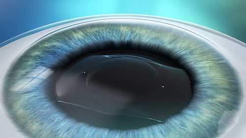 EVO Visian ICL, implantierbare Kontaktlinse, Augenlaserklinik Lohr