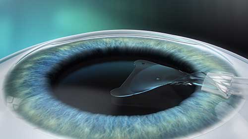EVO Visian ICL, implantierbare Kontaktlinse, Augenlaserklinik Lohr